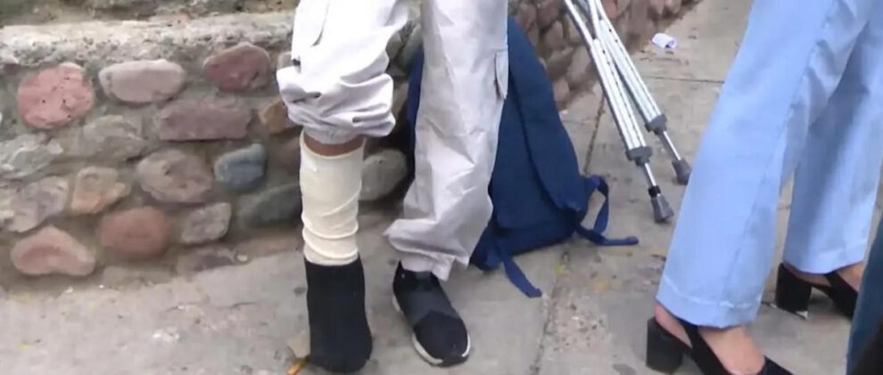 Niña que sufrio una fractura en una de sus piernas tras el robo de su celular