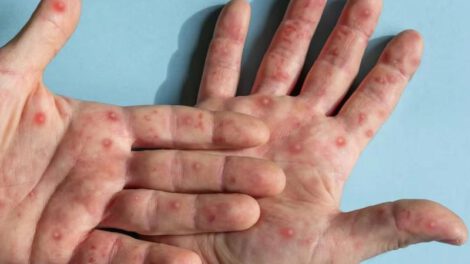 Diez casos en el país