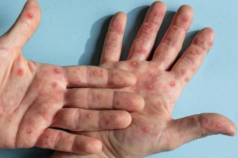 Diez casos en el país