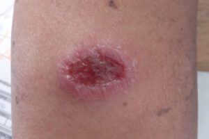 Leishmaniasis