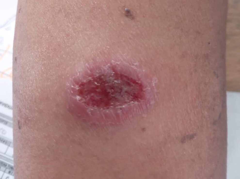 Leishmaniasis