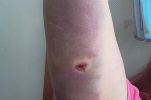 Herida por ataque de can