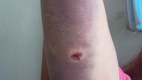 Herida por ataque de can