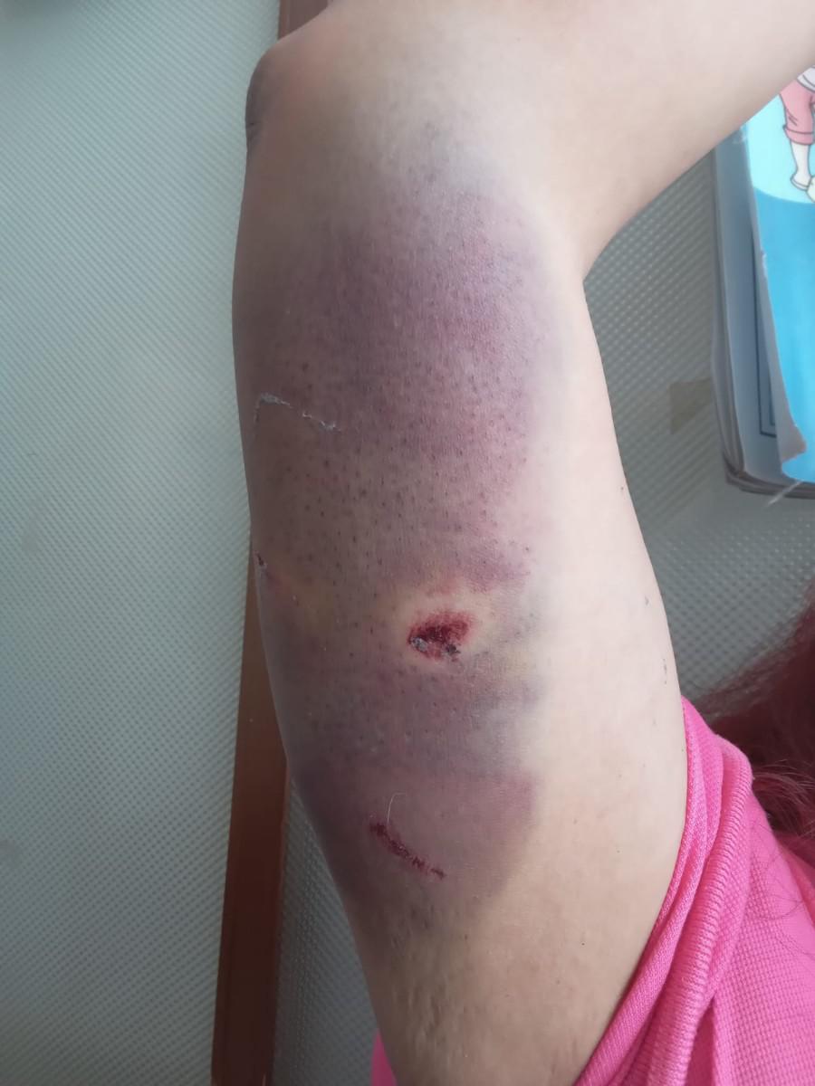 Herida por ataque de can