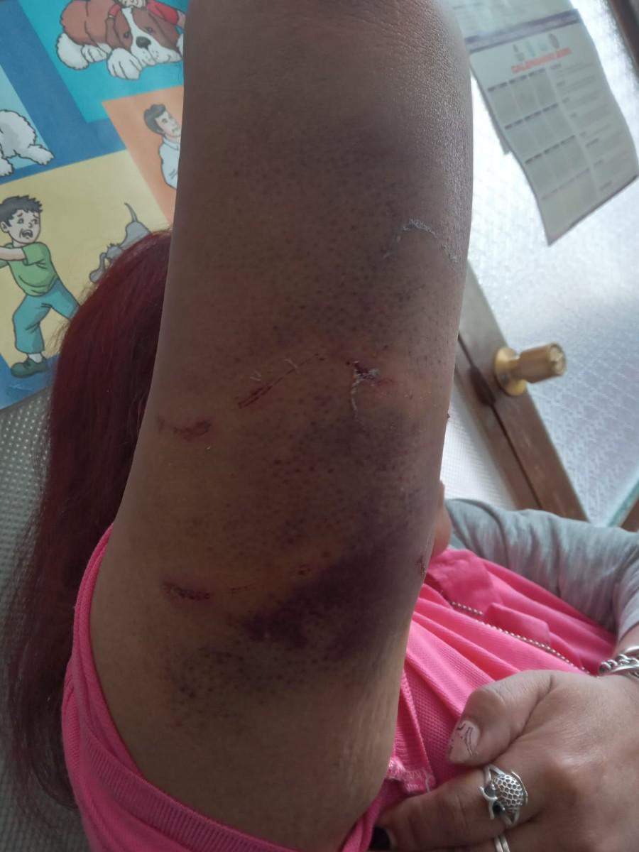 Herida por ataque de can