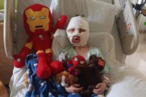 Dominick Krankall sufrió quemaduras graves por bullying