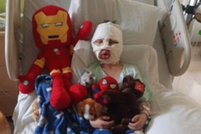 Dominick Krankall sufrió quemaduras graves por bullying