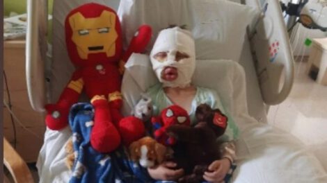 Dominick Krankall sufrió quemaduras graves por bullying