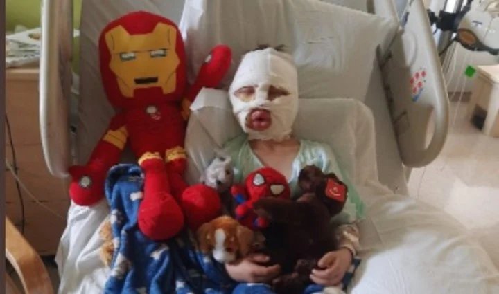 Dominick Krankall sufrió quemaduras graves por bullying