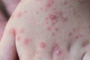 Viruela del mono puede llegar a Bolivia, según médico