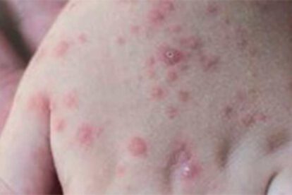 Viruela del mono puede llegar a Bolivia, según médico