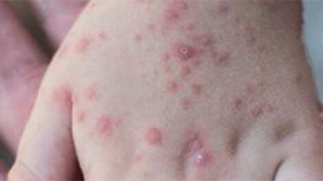 Viruela del mono puede llegar a Bolivia, según médico