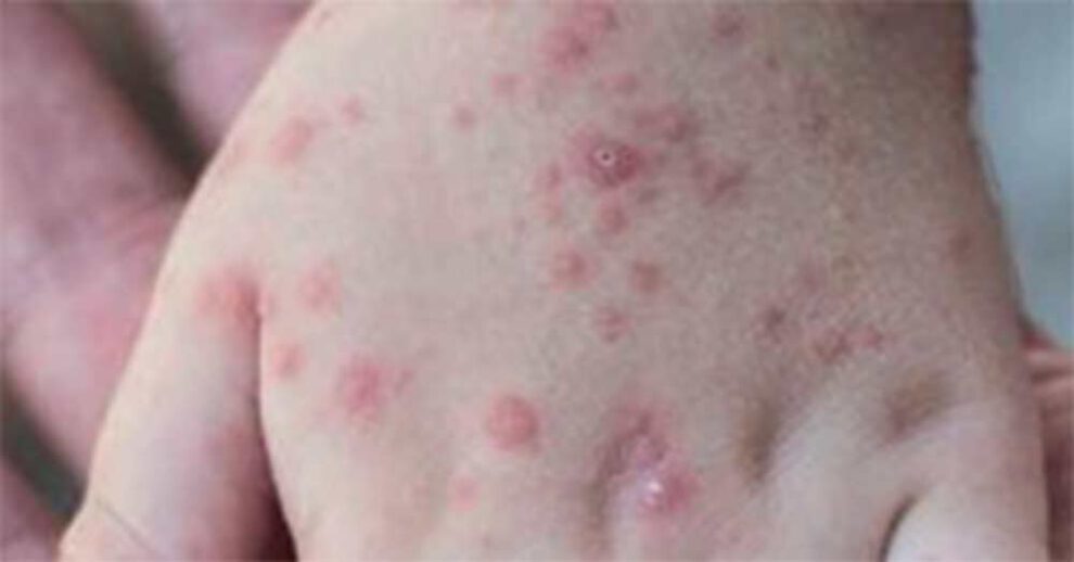 Viruela del mono puede llegar a Bolivia, según médico