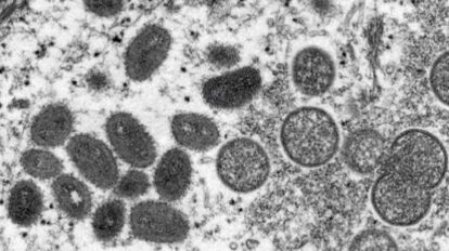 OMS informa de 131 casos de viruela del mono