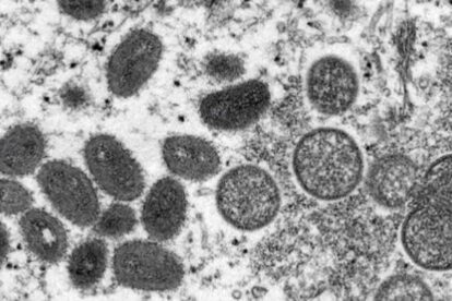 OMS informa de 131 casos de viruela del mono