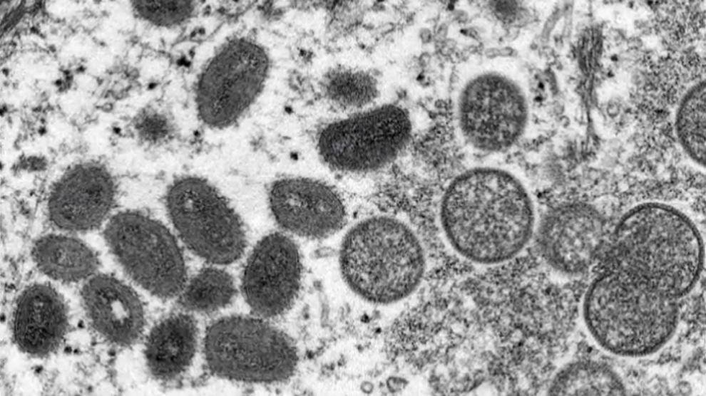 OMS informa de 131 casos de viruela del mono