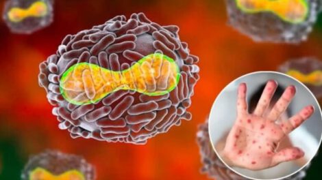 Suman 257 casos de viruela del mono en 23 países, dice la OMS