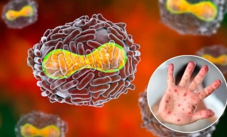 Suman 257 casos de viruela del mono en 23 países, dice la OMS