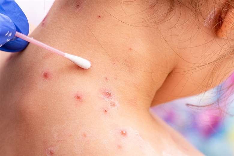 Resultados de los primeros casos sospechosos de viruela del mono en Santa Cruz
