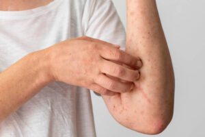 Ampulaciones en el cuerpo humano, síntomas de la viruela del mono