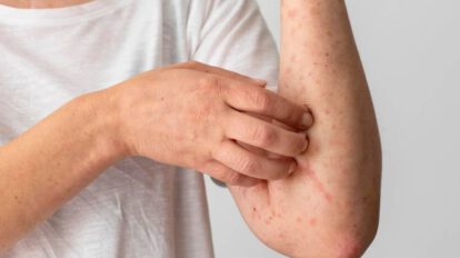 Ampulaciones en el cuerpo humano, síntomas de la viruela del mono