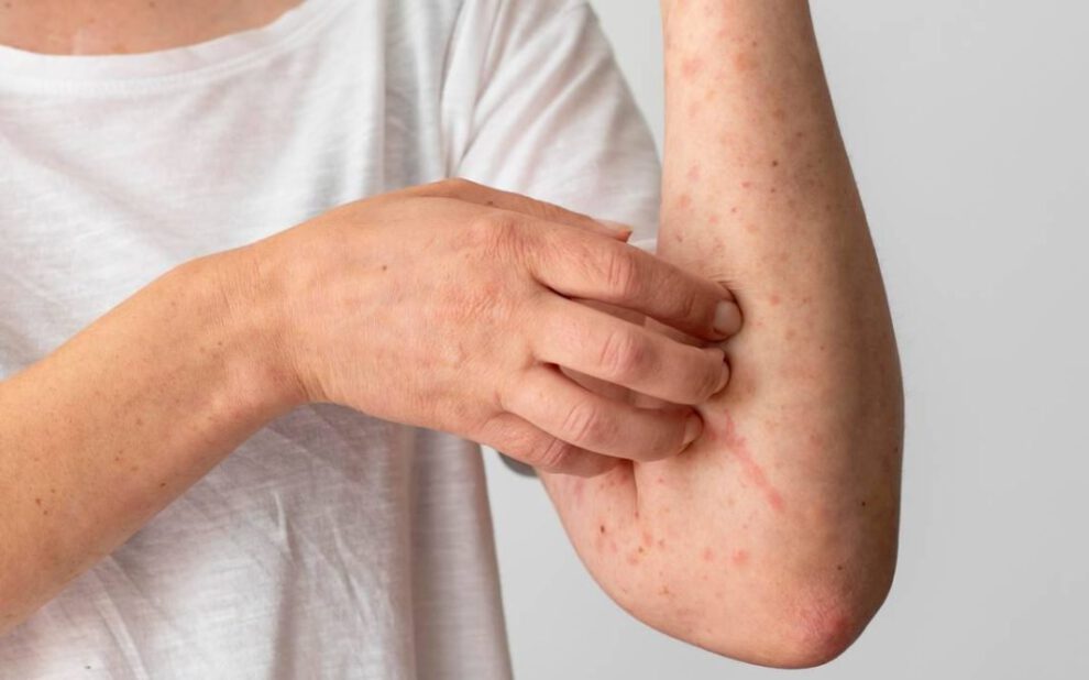 Ampulaciones en el cuerpo humano, síntomas de la viruela del mono