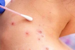 Un paciente infectado con la viruela símica