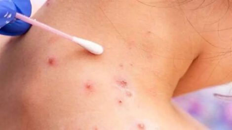 Un paciente infectado con la viruela símica