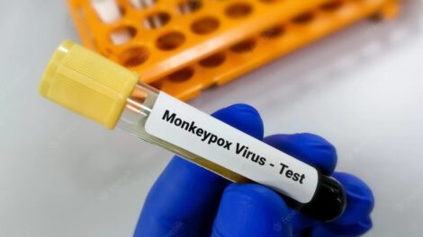 Muestra del virus de la viruela del mono en Bolivia