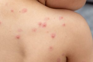 Viruela del mono puede causar problemas en el corazón