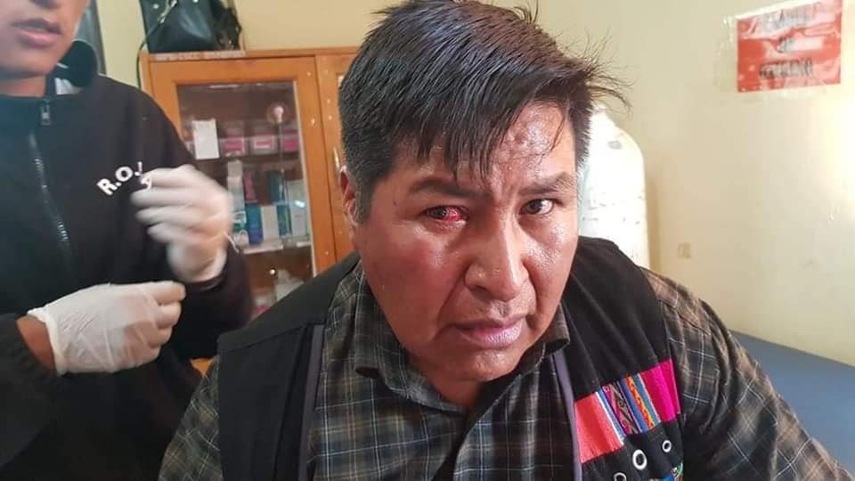 Destitución director de Culturas Uncía, Martín Choque con lesiones en el ojo derecho