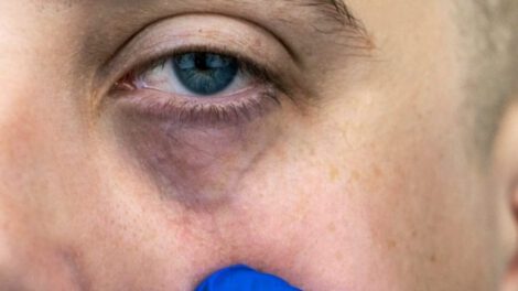 Eliminar las ojeras de forma natural