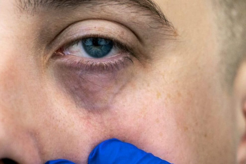 Eliminar las ojeras de forma natural