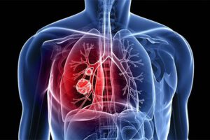 Inteligencia Artificial contra la fibrosis pulmonar