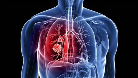Inteligencia Artificial contra la fibrosis pulmonar