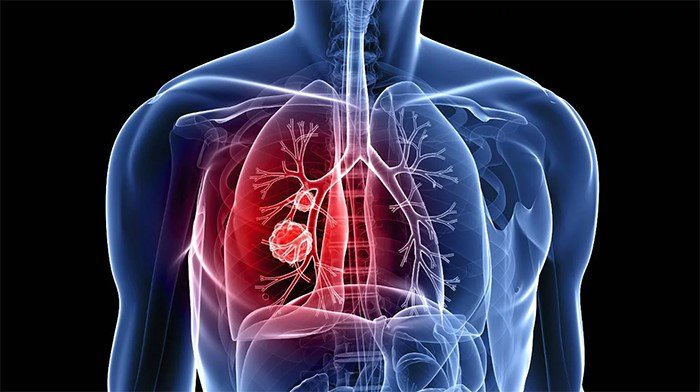 Inteligencia Artificial contra la fibrosis pulmonar