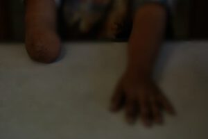 Accidentes domésticos que resultan en amputaciones de niños