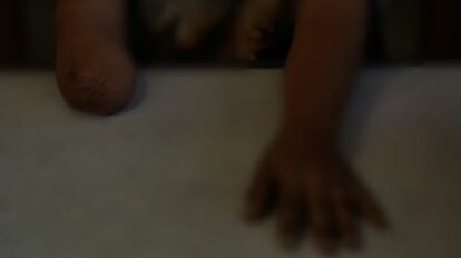 Accidentes domésticos que resultan en amputaciones de niños