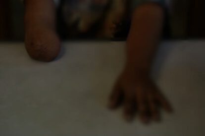 Accidentes domésticos que resultan en amputaciones de niños