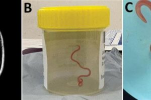 Lombriz intestinal en cerebro de mujer australiana