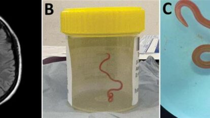 Lombriz intestinal en cerebro de mujer australiana
