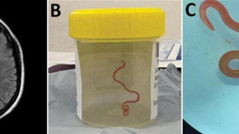 Lombriz intestinal en cerebro de mujer australiana