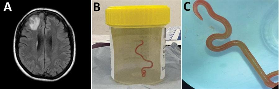 Lombriz intestinal en cerebro de mujer australiana