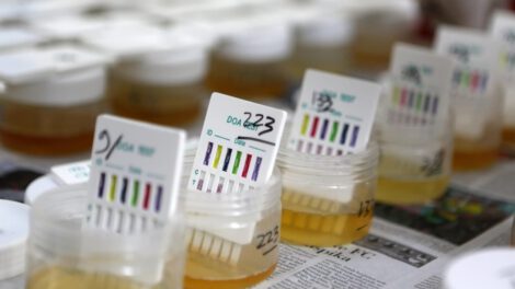 Color amarillo de la orina y su causa descubierta por científicos