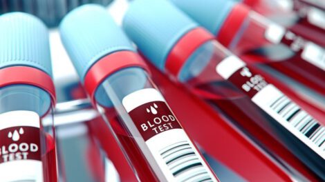 Análisis de sangre Alzheimer
