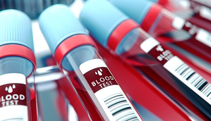 Análisis de sangre Alzheimer