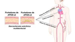 Gen relacionado con el alzhéimer y aterosclerosis subclínica