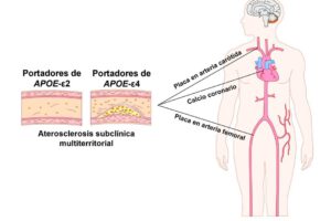 Gen relacionado con el alzhéimer y aterosclerosis subclínica
