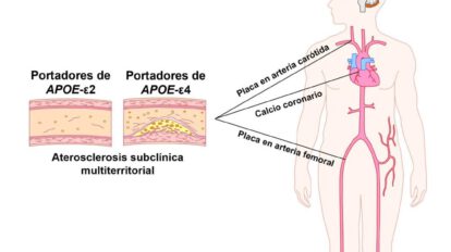 Gen relacionado con el alzhéimer y aterosclerosis subclínica