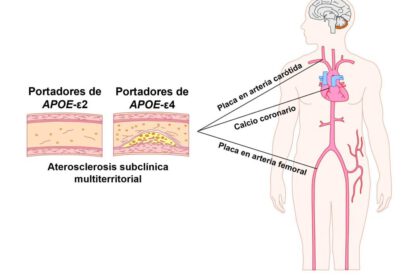 Gen relacionado con el alzhéimer y aterosclerosis subclínica